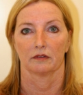 Feel Beautiful - Facelift San Diego Case 15 - Before Photo